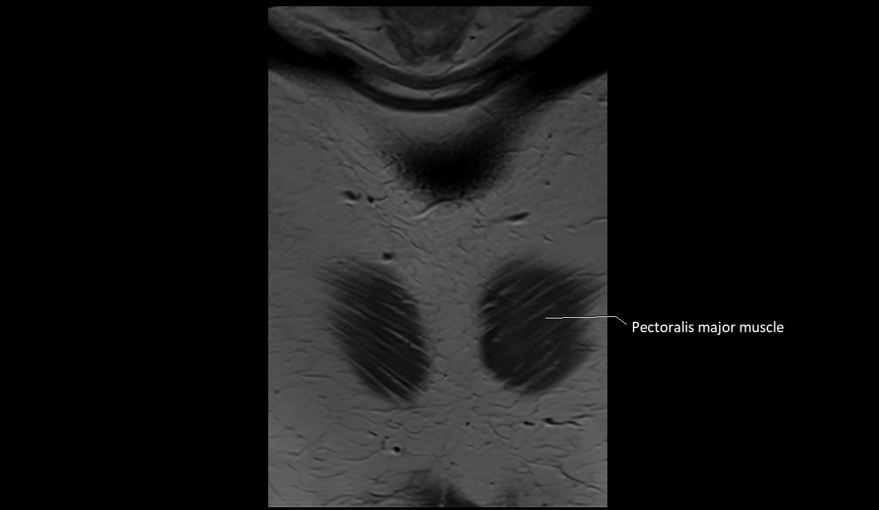 MRI sternum and sternoclavicular joint labeled coronal anatomy image 1.webp